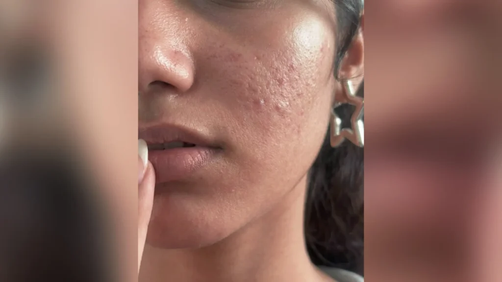 ai generated side profile showing dimples pimples and natural skin imperfections